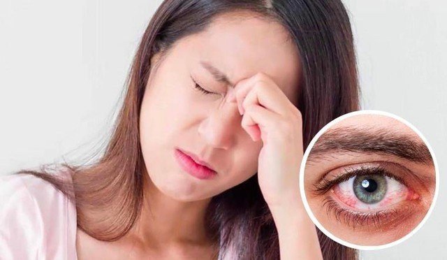 Những điều cần biết, đề phòng đau mắt đỏ